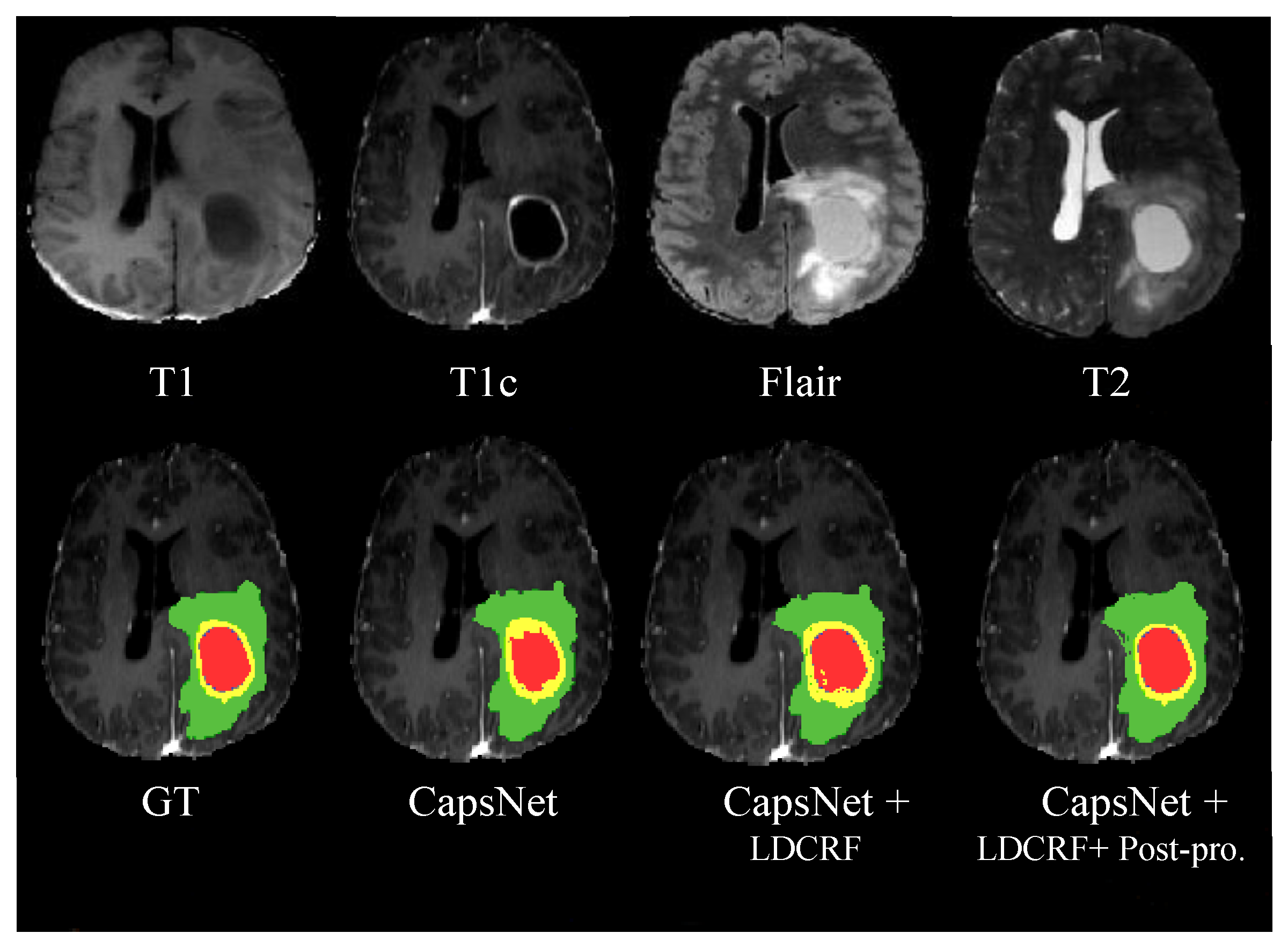 J. Imaging | Free Full-Text | Brain Tumor Segmentation Using Deep ...