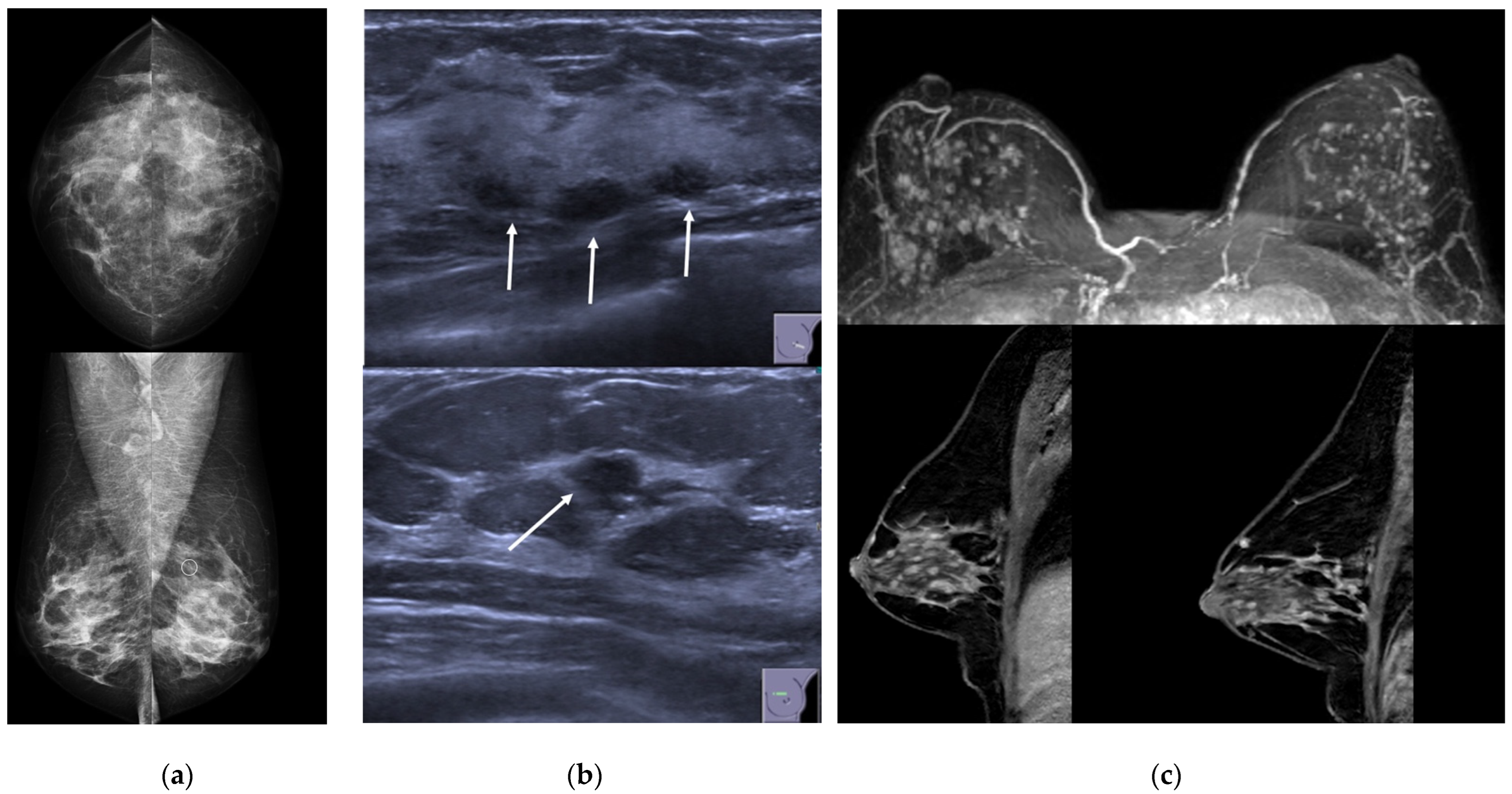 SciELO - Brasil - Breast imaging in patients with nipple discharge Breast  imaging in patients with nipple discharge