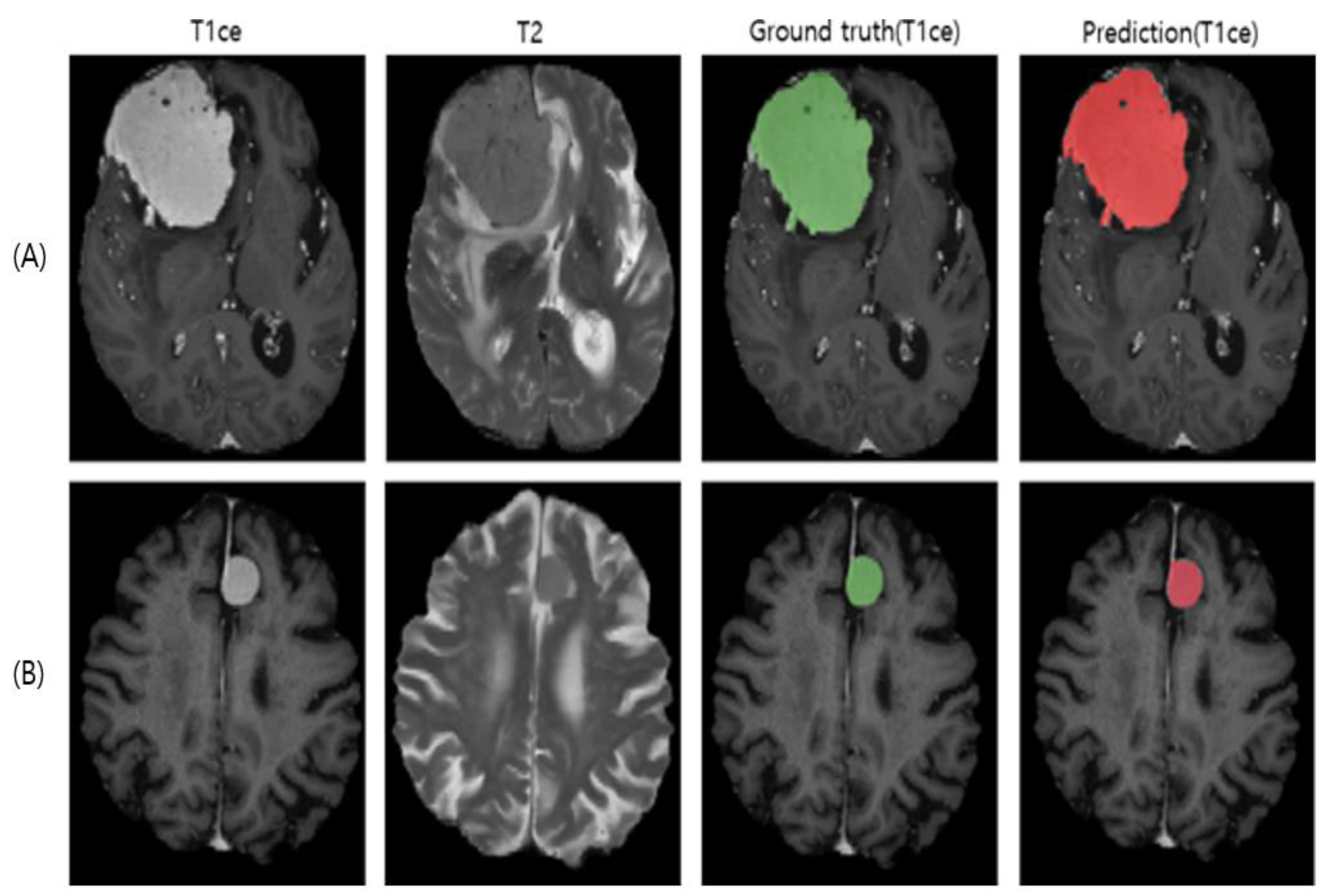 J Imaging Free Full Text Fully Automated Segmentation Models Of Supratentorial Meningiomas 