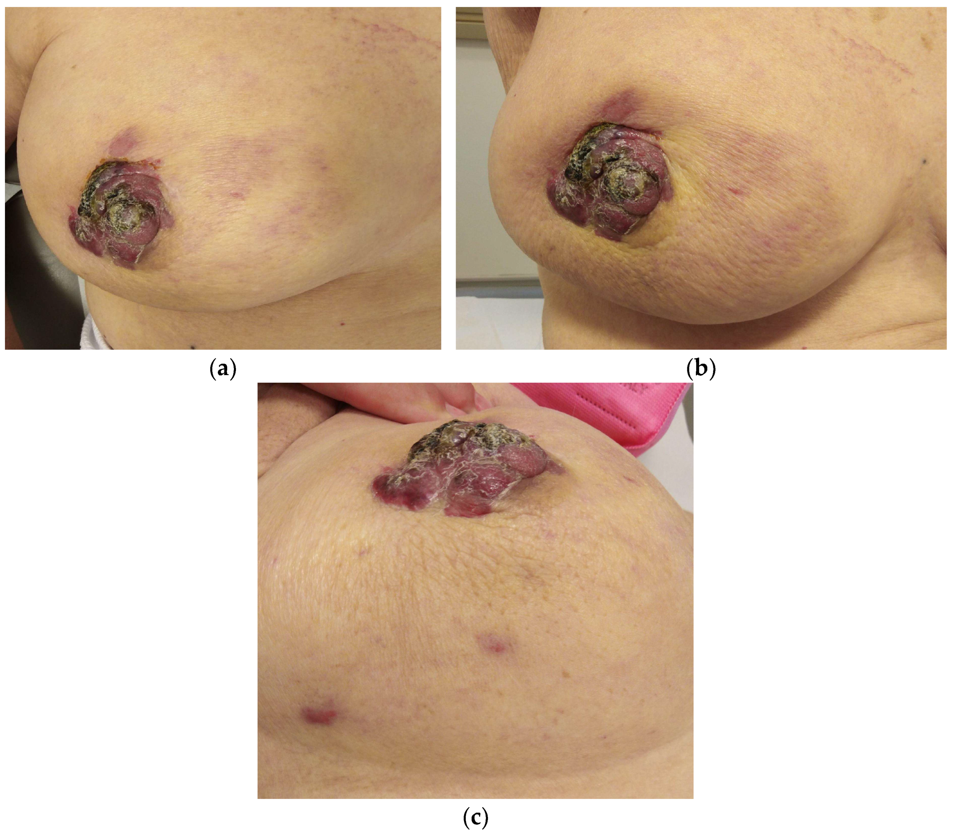 Axillary manifestations of dermatologic diseases: a focused review