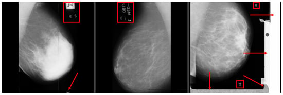 Case 4; Mammography of right breast lesions (pointed by arrows)
