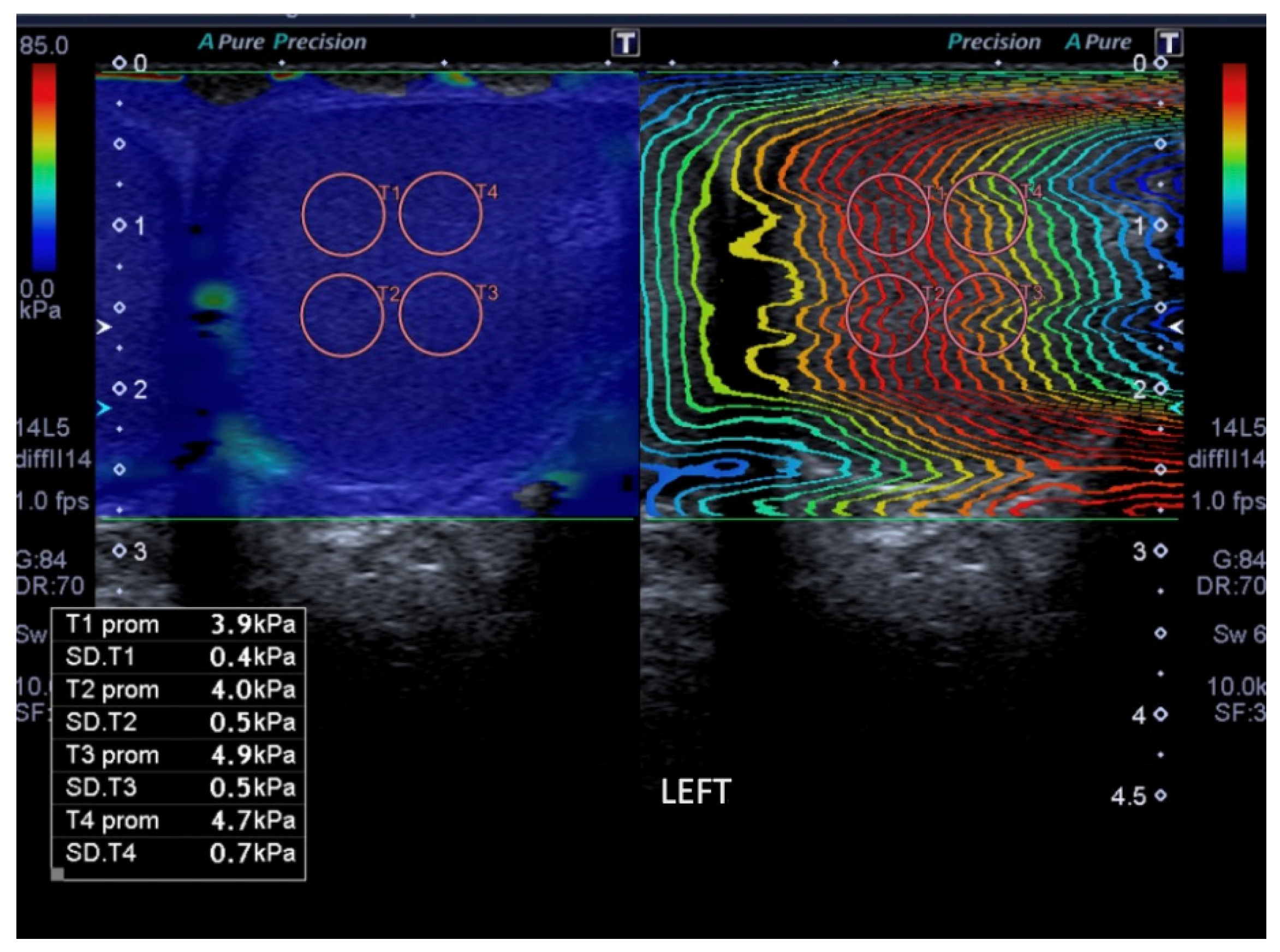 varicocele ultrasound criteria