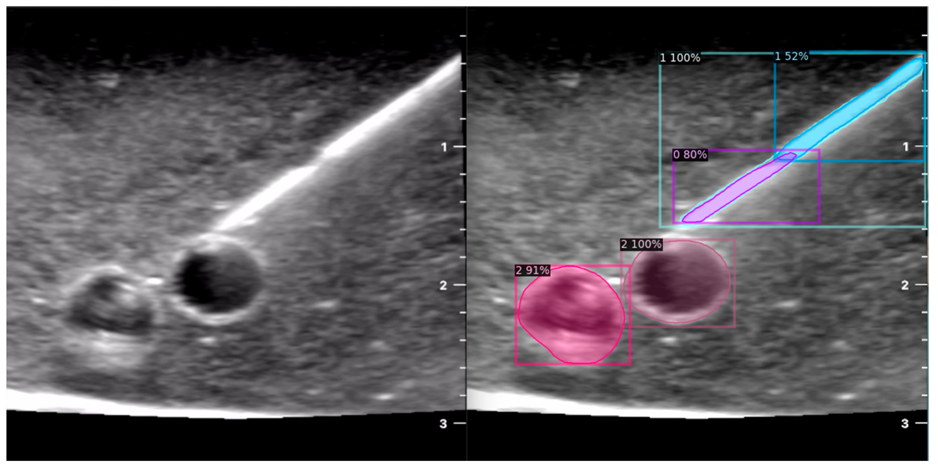 Leveraging Datature Nexus for Tumor and Anomaly Detection in Medical Scans  : Part I