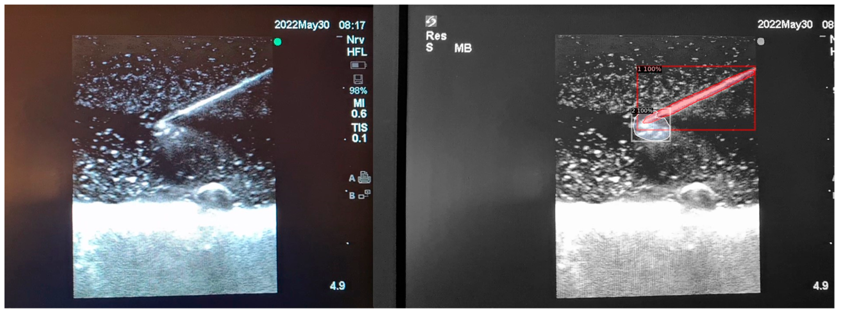 Leveraging Datature Nexus for Tumor and Anomaly Detection in Medical Scans  : Part I