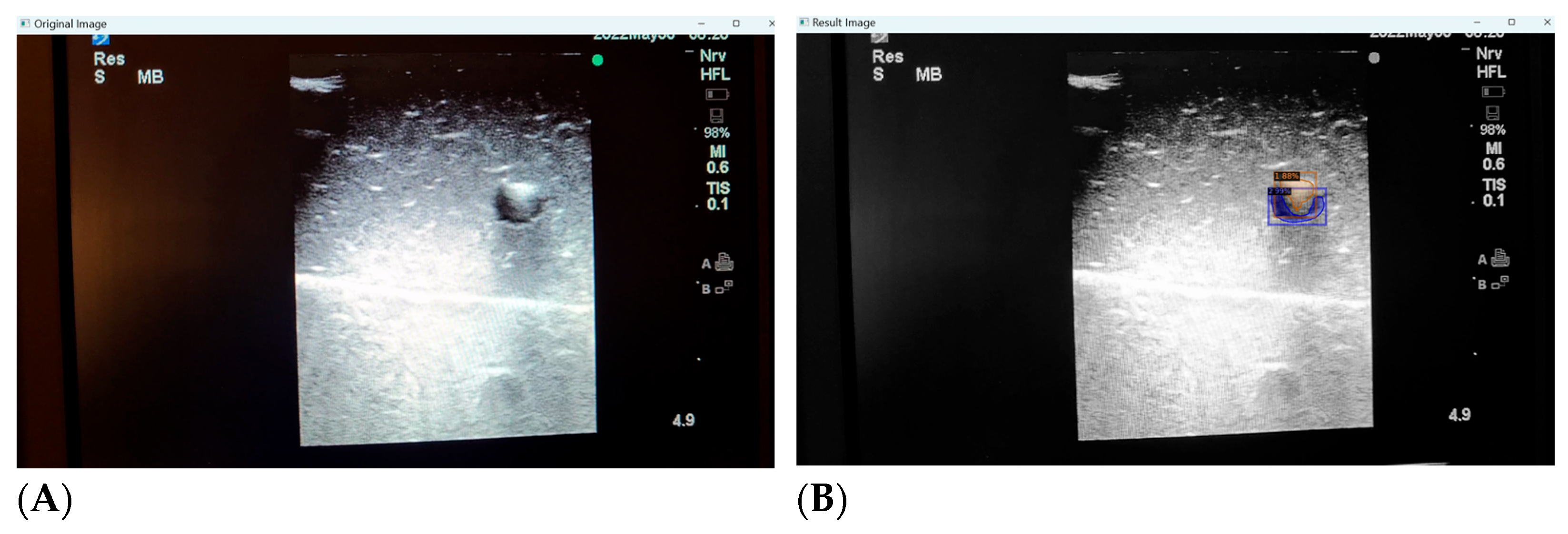 Leveraging Datature Nexus for Tumor and Anomaly Detection in Medical Scans  : Part I