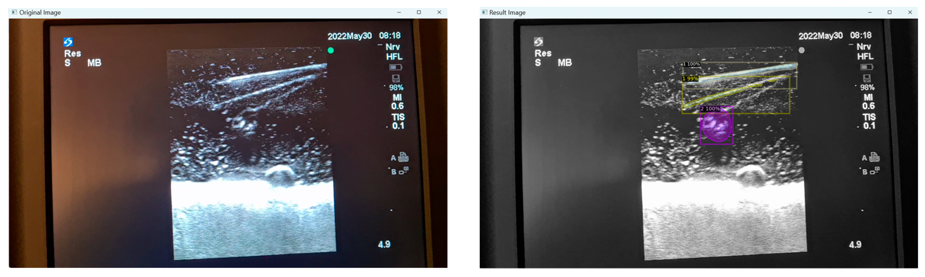 Leveraging Datature Nexus for Tumor and Anomaly Detection in Medical Scans  : Part I