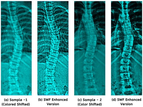 Study Affirms Benefit of Back Braces as Scoliosis Treatment - The New York  Times