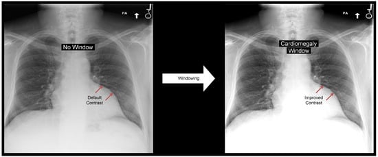 J. Imaging | Free Full-Text | WindowNet: Learnable Windows for Chest X ...