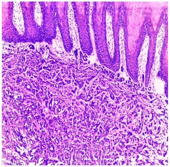 JMP | Free Full-Text | Sinonasal Hyalinizing Adenoid Cystic Carcinoma ...