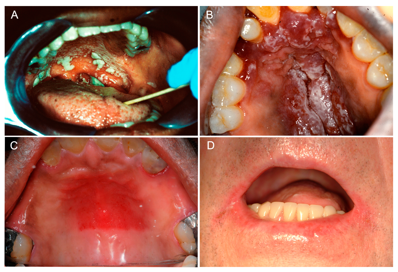 JoF | Free Full-Text | Oral Candidiasis: A Disease of Opportunity | HTML
