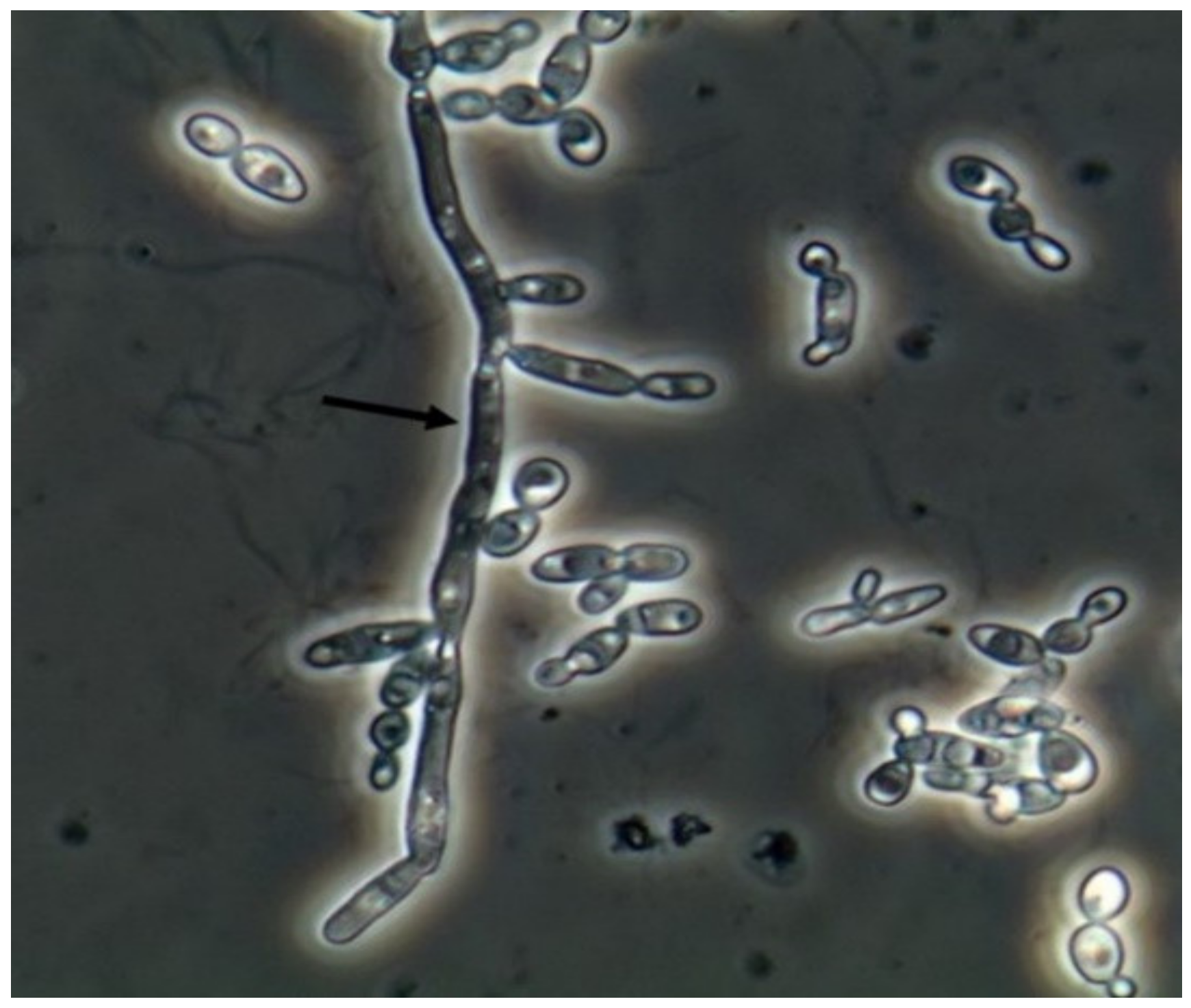 Jof Free Full Text Urine Sediment Findings And The Immune Response To Pathologies In Fungal 0782