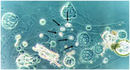 Jof Free Full Text Urine Sediment Findings And The Immune Response To Pathologies In Fungal 9303