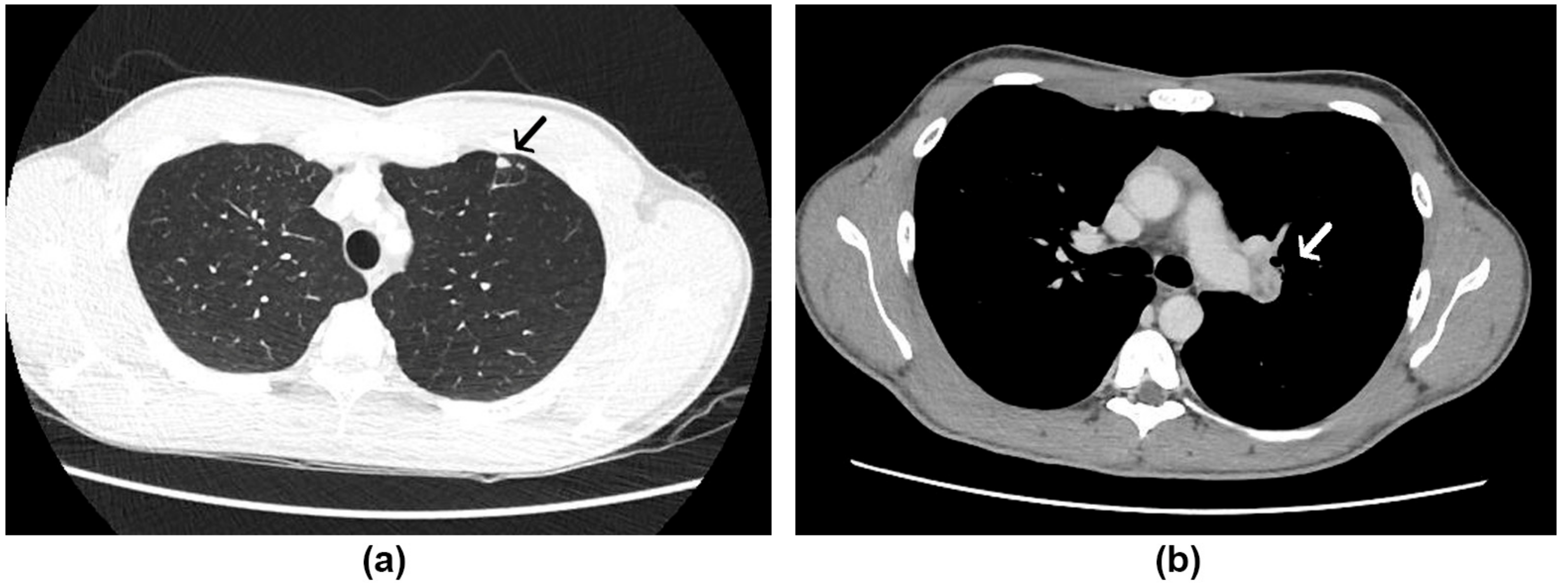 Histoplasmosis Awareness: Heart, Lungs, Eyes • Ads of the World™