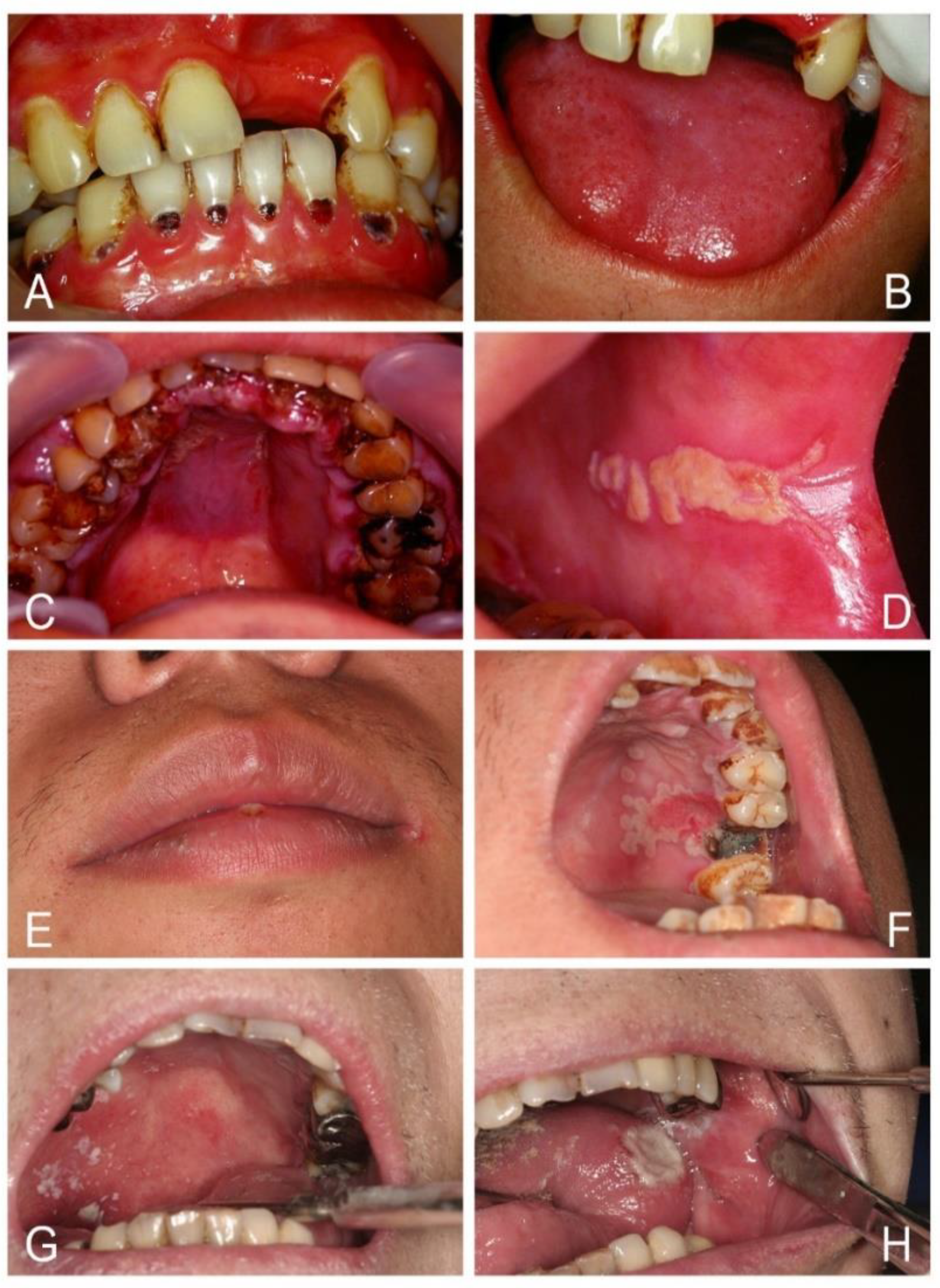mild oral candidiasis