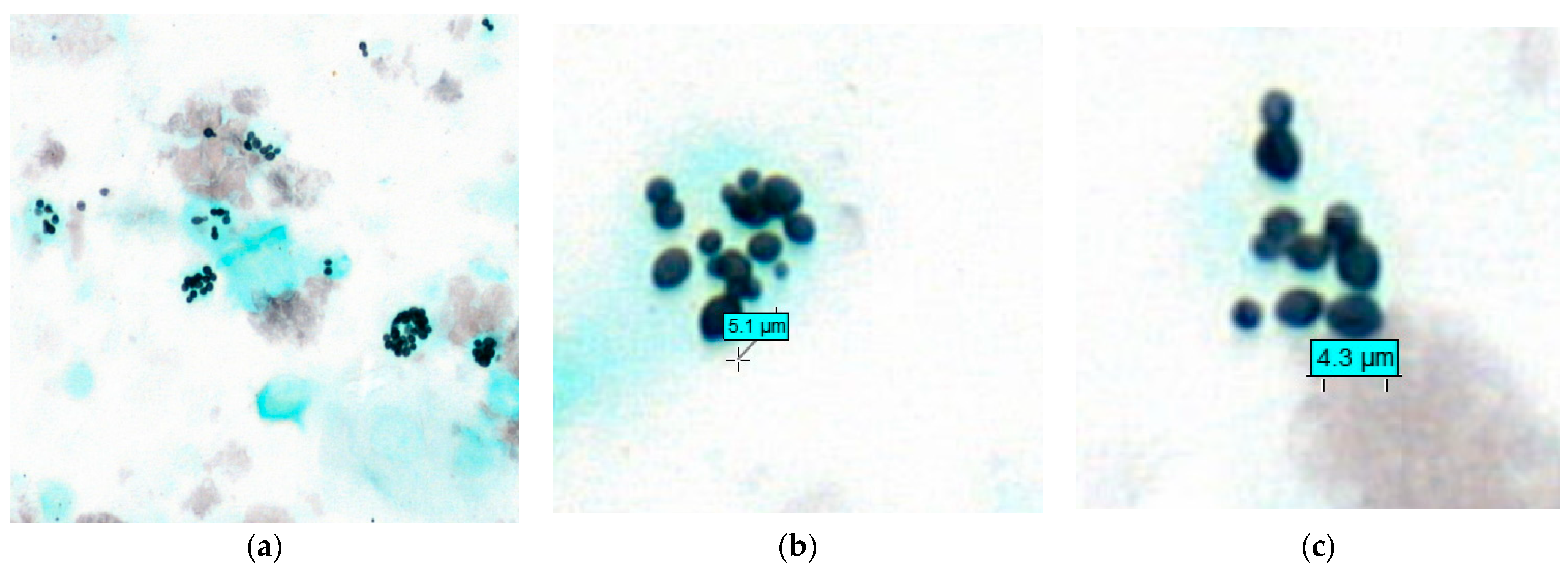 JoF | Free Full-Text | Cytological Spectrum of Pulmonary Histoplasmosis  Diagnosed by Bronchoalveolar Lavage: 12 Years of Experience in French Guiana