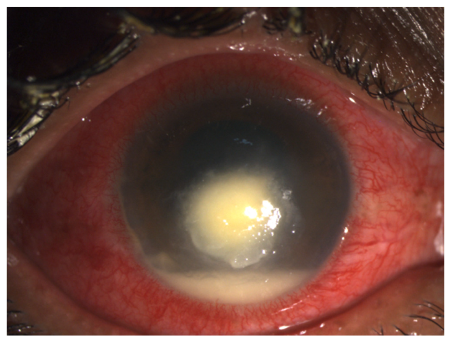fungal corneal ulcer satellite lesion