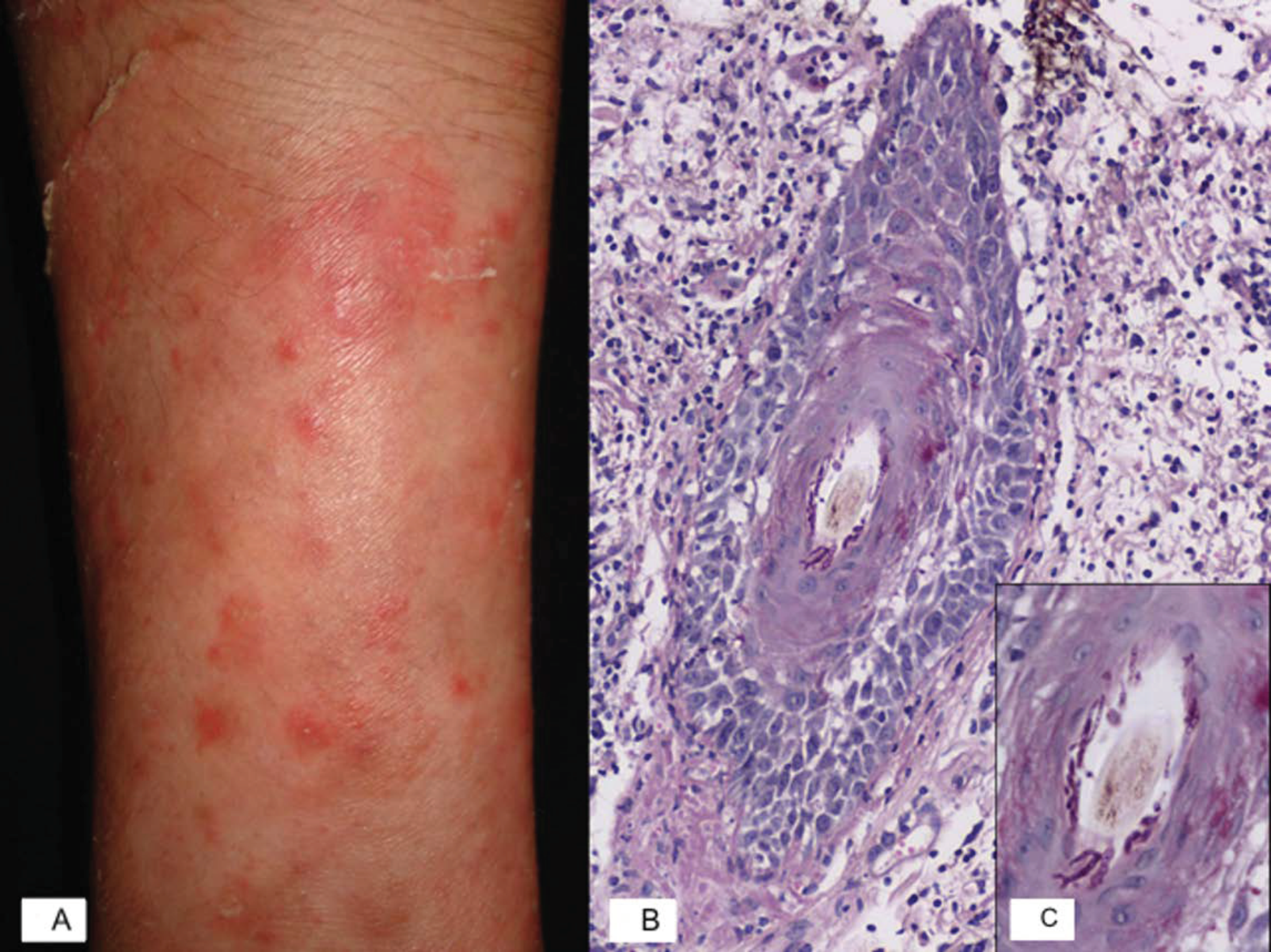 Tinea manuum caused by Microsporum canis. The patient presented with a