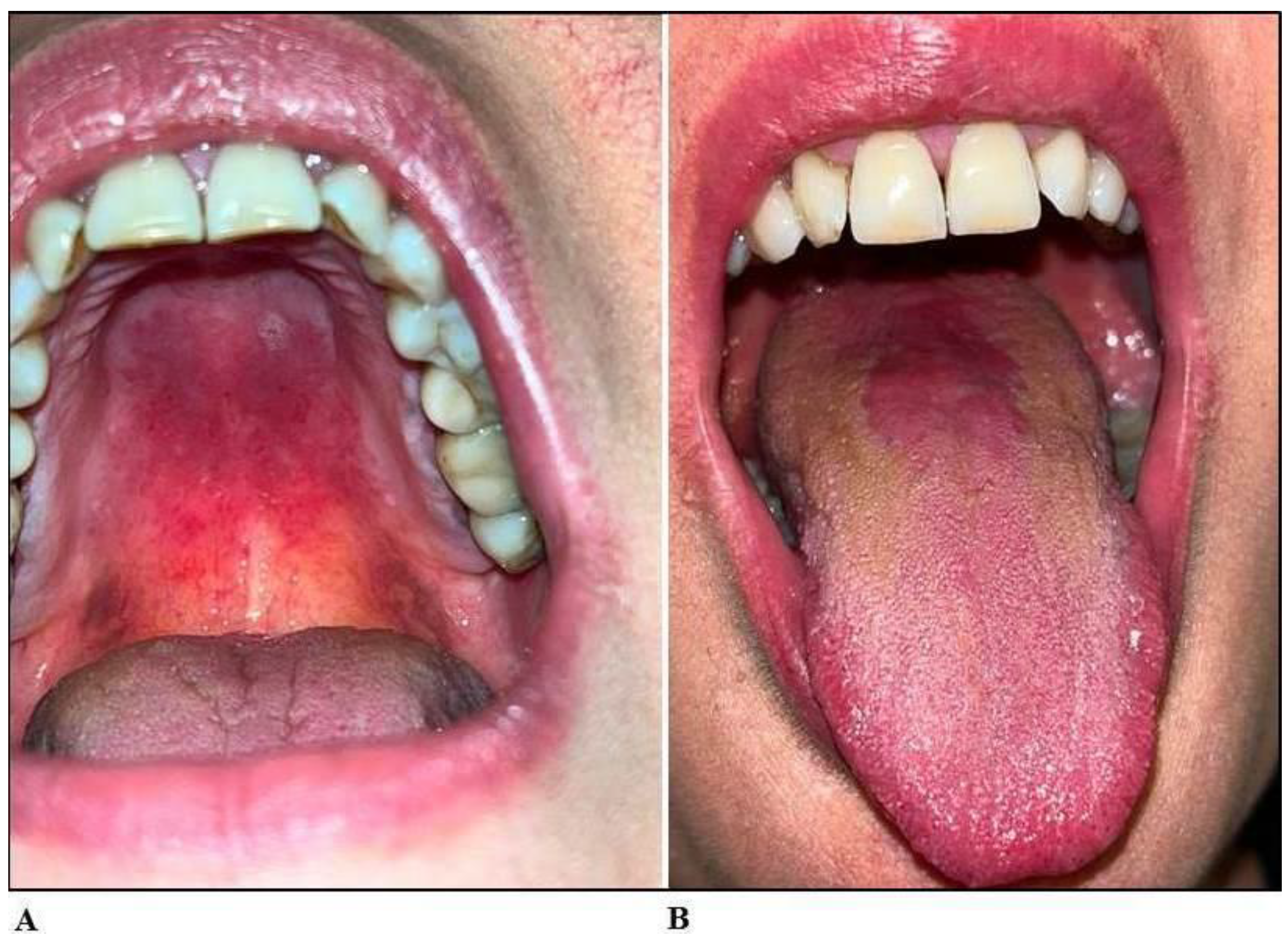 JoF | Free Full-Text | An Unconventional Oral Candidiasis in an  Immunocompetent Patient