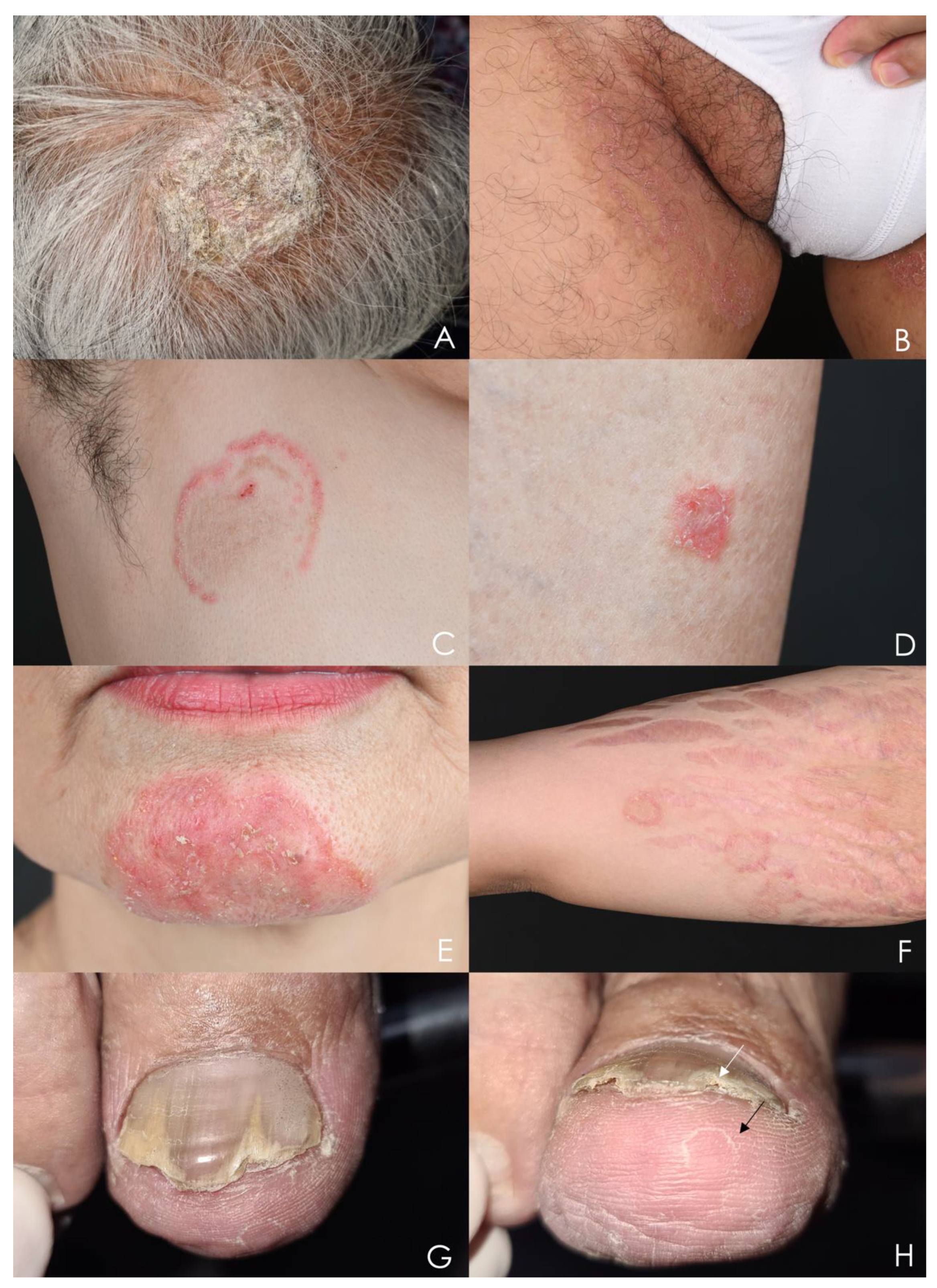 What Is Tinea Manuum And Who Is Most At Risk?