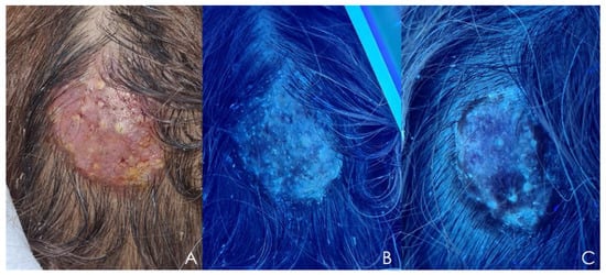 A: Tinea pedis in toe web; B: Tinea capitis showing scaring, alopecia; C: Tinea  unguium of the nail plate - Indian J Microbiol Res