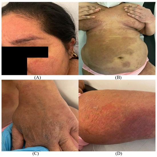 Tinea manuum: A report of 18 cases observed in the metropolitan