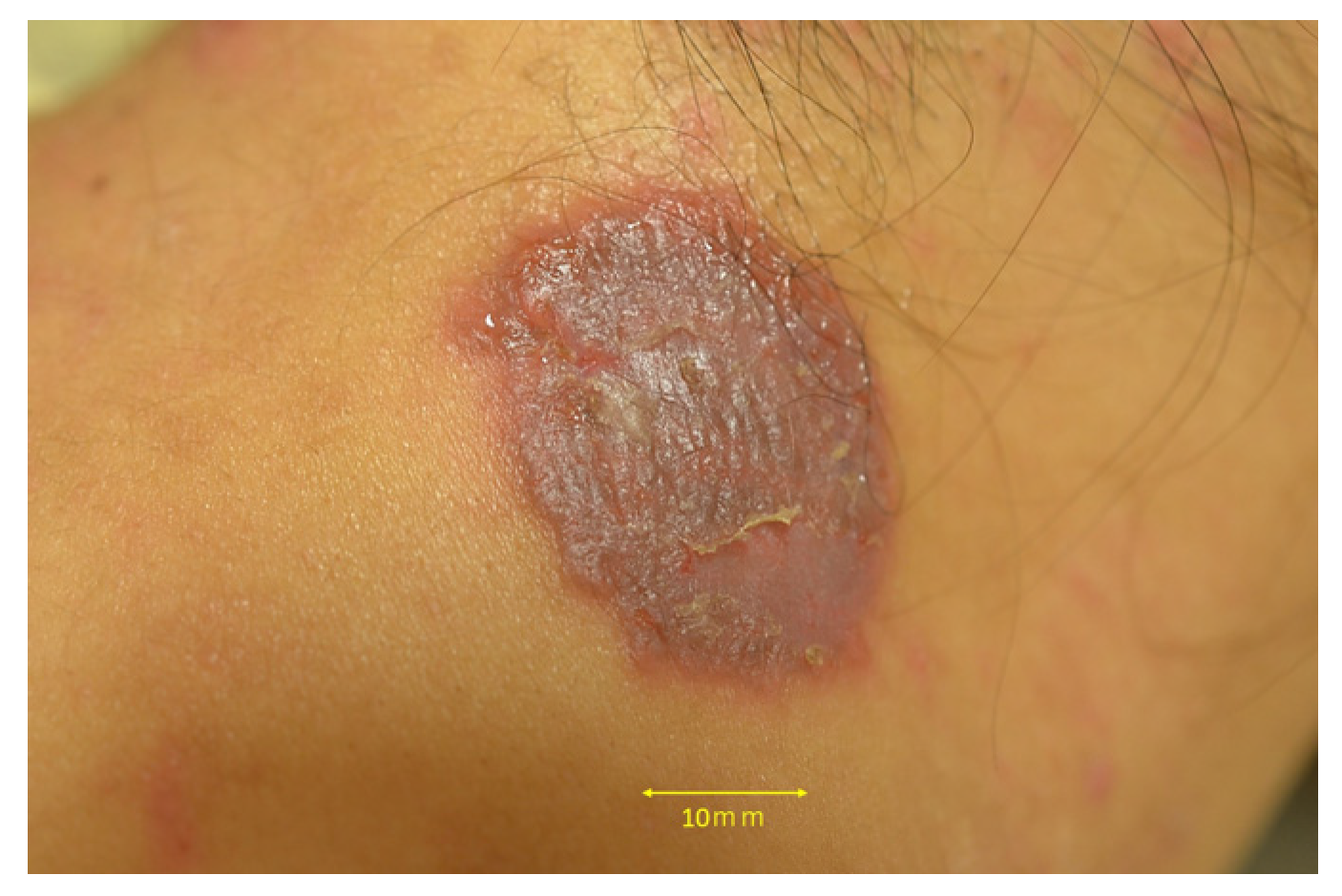 Inflammatory Tinea Manuum due to Trichophyton Erinacei from a