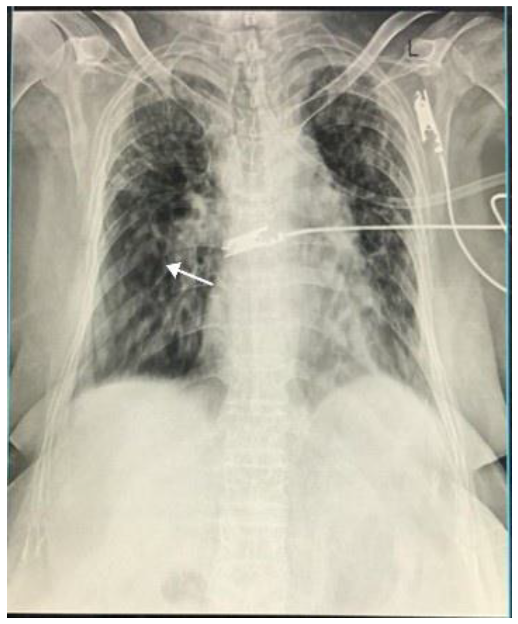 JoR | Free Full-Text | An Interesting Case of Allergic Bronchopulmonary  Aspergillosis Resulting in Type II Respiratory Failure