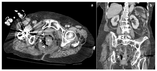 JPM | Free Full-Text | Spontaneous Rectal Perforation in a Patient with ...