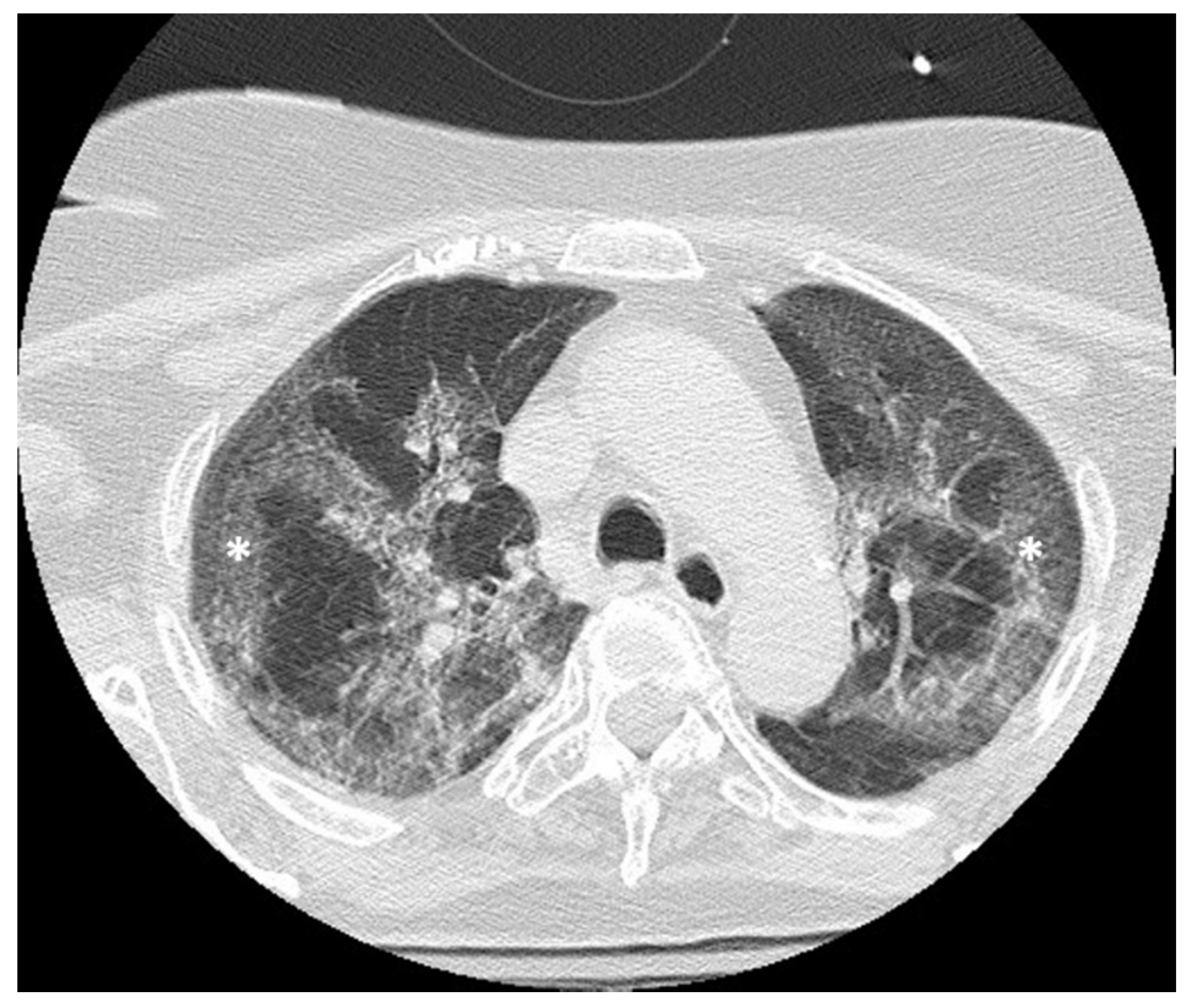 Jpm Free Full Text Spontaneous Rectal Perforation In A Patient With Sars Cov 2 Infection Html