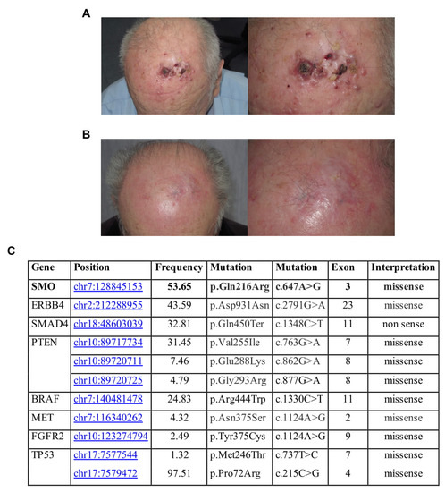Jpm Free Full Text Treatment Of Cutaneous Melanoma Harboring Smo P Gln216arg Mutation With Imiquimod An Old Drug With New Results Html