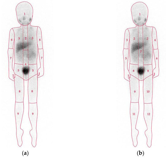 Aj Lee Porn Look Like - JPM | Free Full-Text | Nuclear Medicine Imaging in Neuroblastoma: Current  Status and New Developments