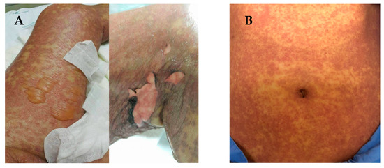 Jpm Free Full Text Genetic Determinants In Hla And Cytochrome P450 Genes In The Risk Of Aromatic Antiepileptic Induced Severe Cutaneous Adverse Reactions Html