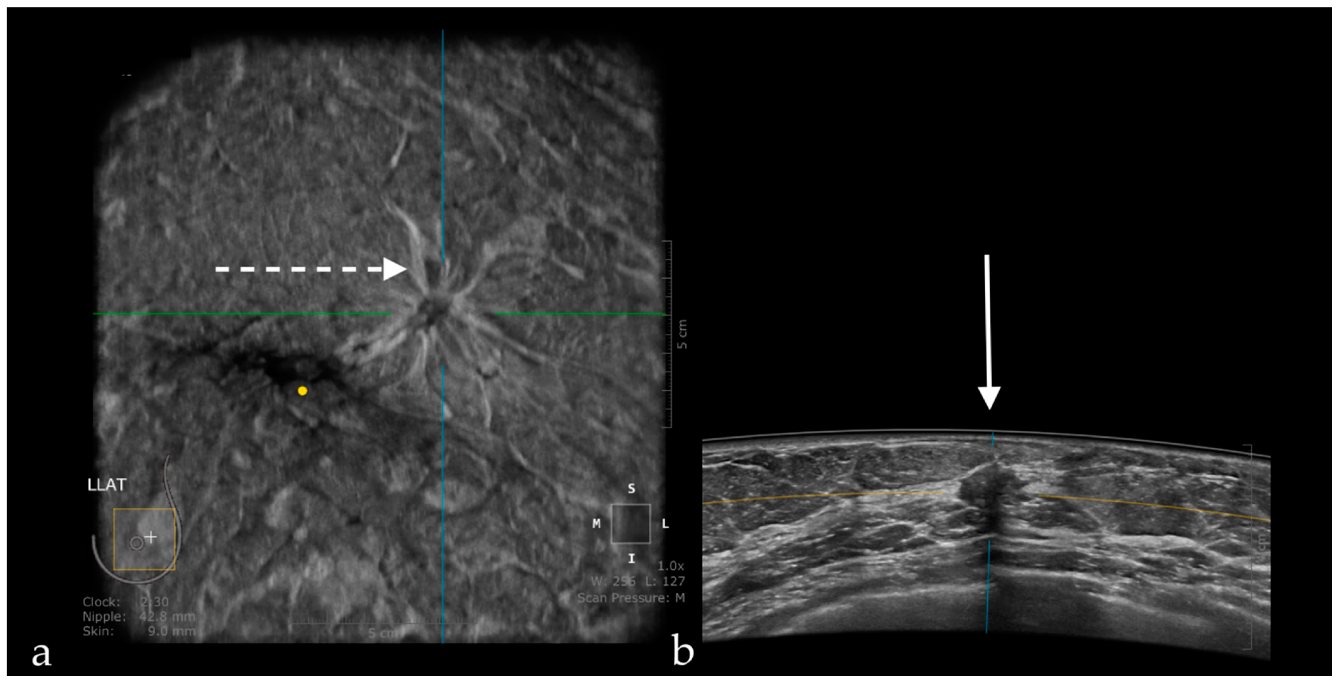 JPM | Free Full-Text | Pros and Cons for Automated Breast Ultrasound (ABUS):  A Narrative Review