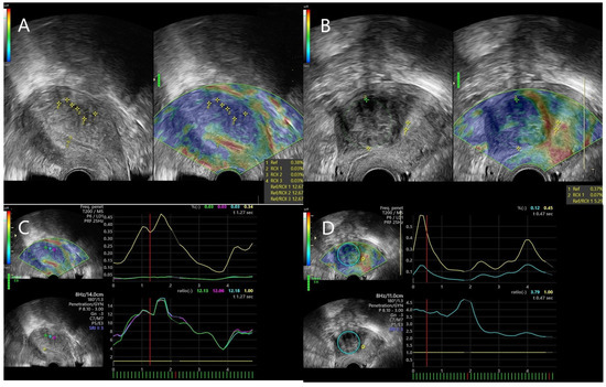 Jpm Free Full Text Value Of Strain Ratio Elastography In The Diagnosis And Differentiation 5329