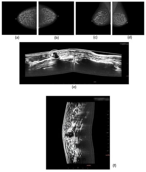 3D mammography detected 34% more breast cancers in screening •