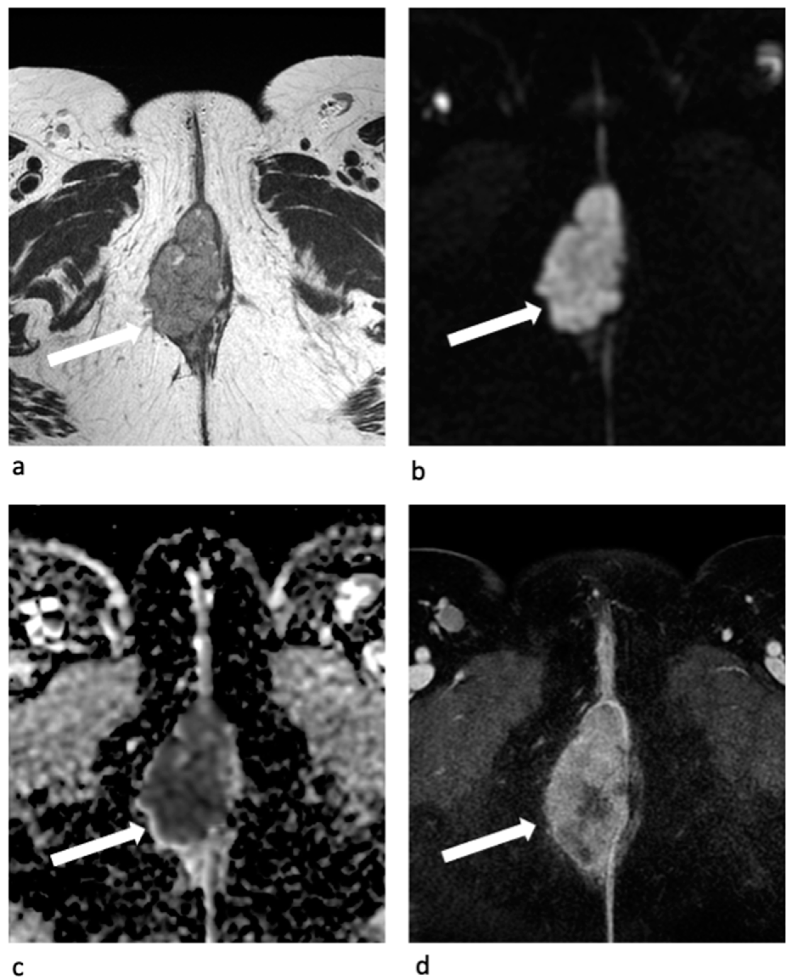 Jpm Free Full Text Mri Staging In Locally Advanced Vulvar Cancer From Anatomy To Clinico 4939