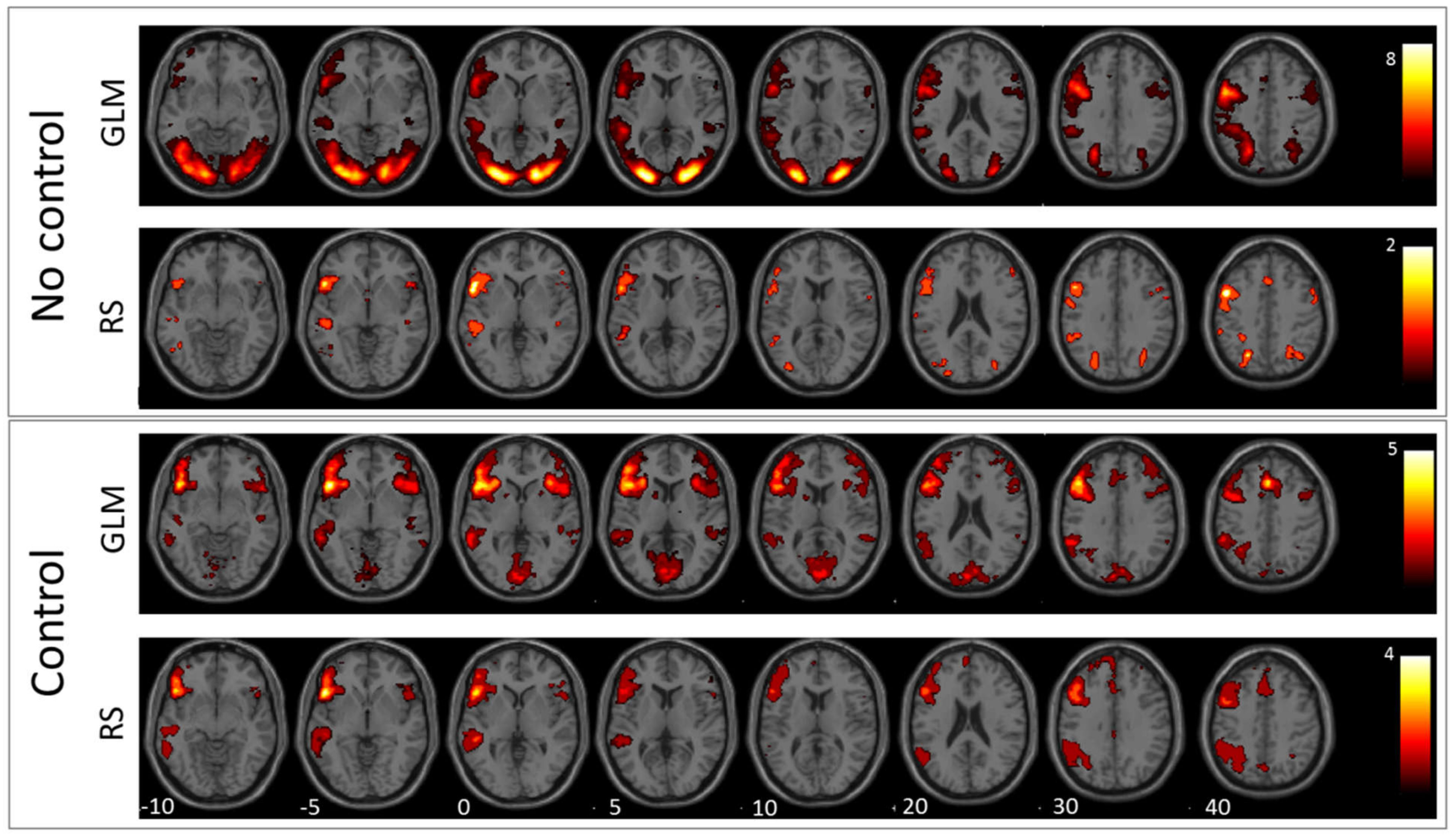 Jpm Free Full Text Preoperative Assessment Of Language Dominance Through Combined Resting State And Task Based Functional Magnetic Resonance Imaging Html