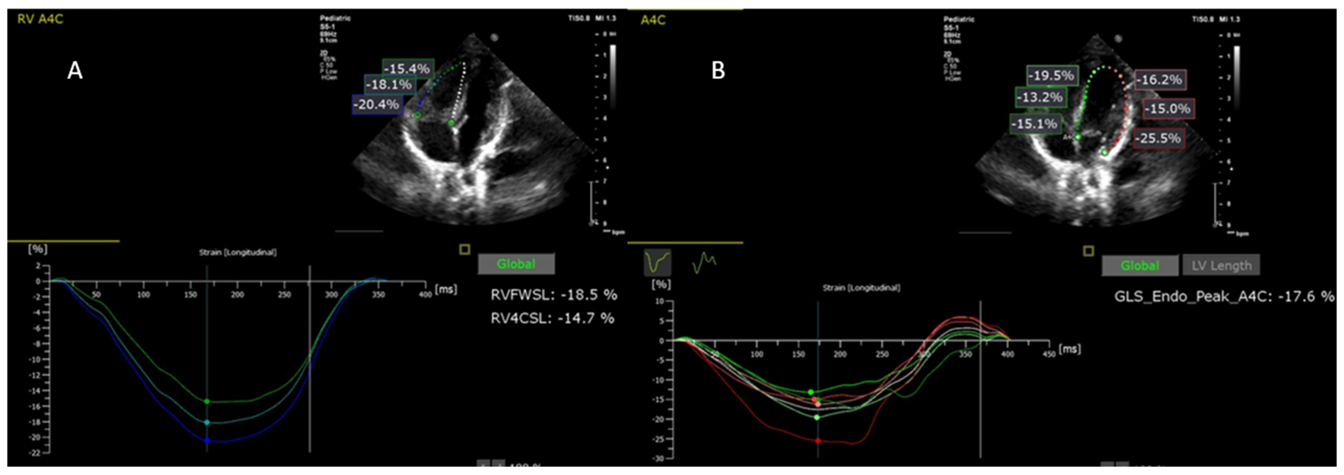 Normal left ventricular mechanics by two-dimensional speckle-tracking  echocardiography. Reference values in healthy adults.