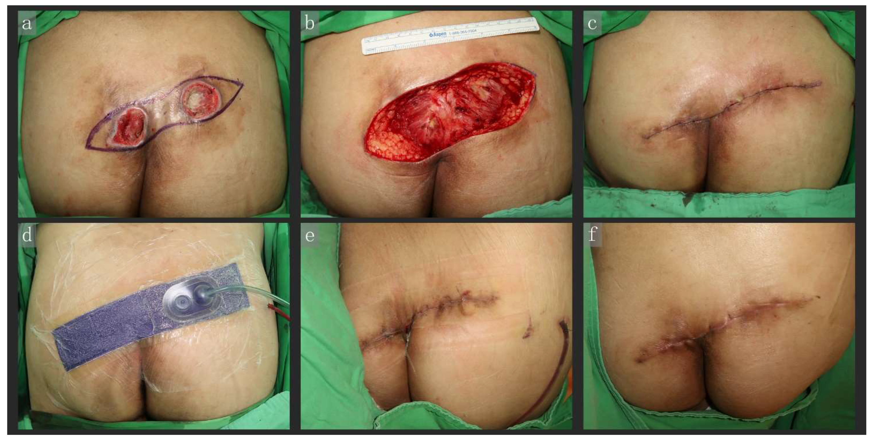 Appearance of the right breast after wound cleaning. A large ulcer is