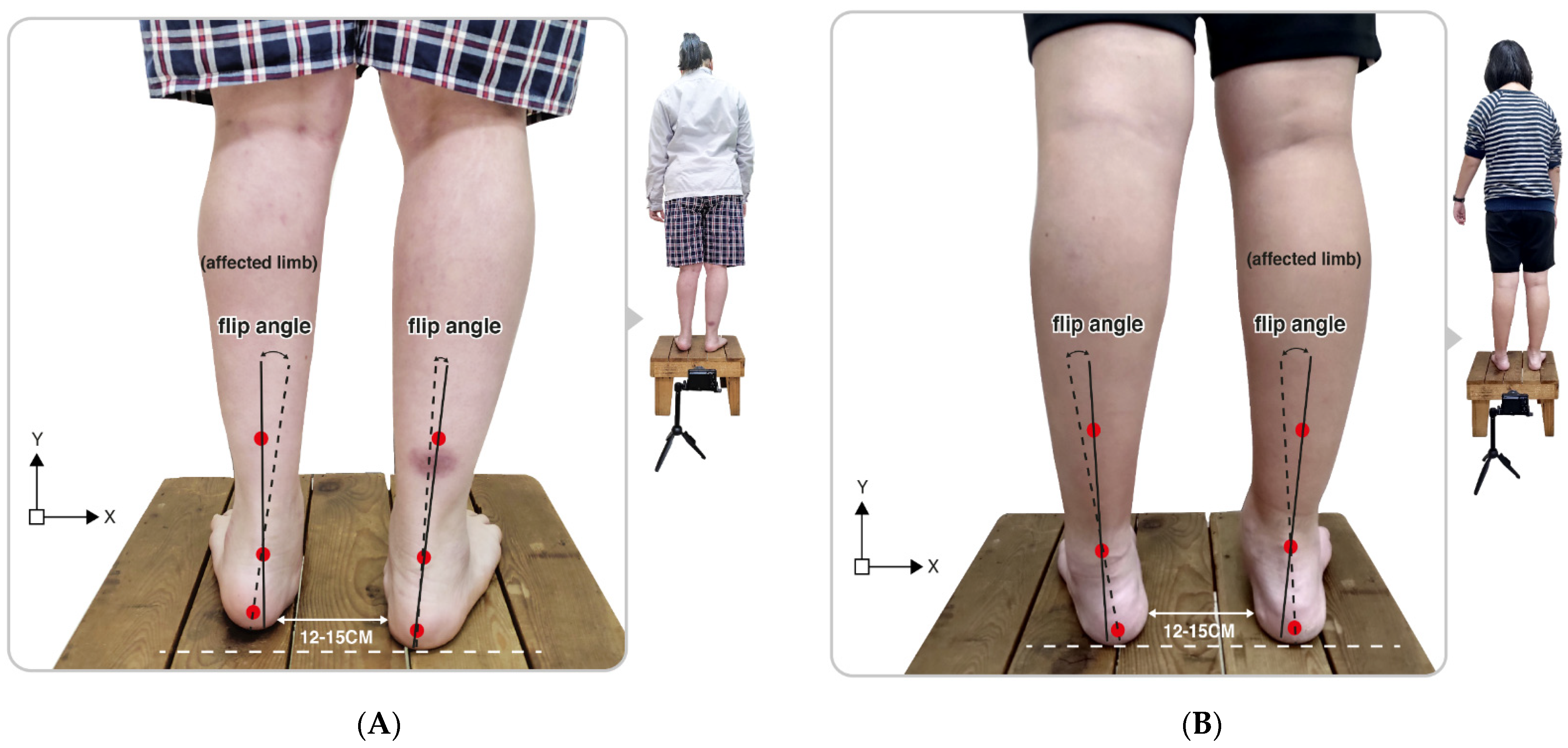 JPM | Free Full-Text | Traceable Features of Static Plantar Pressure  Characteristics and Foot Postures in College Students with Hemiplegic  Cerebral Palsy | HTML