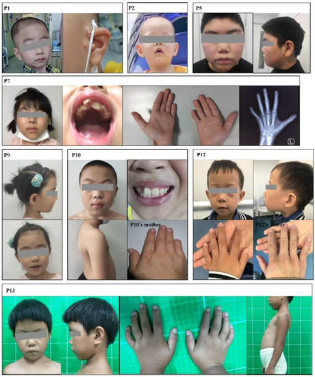 Small and short hands in girl with Cohen syndrome.