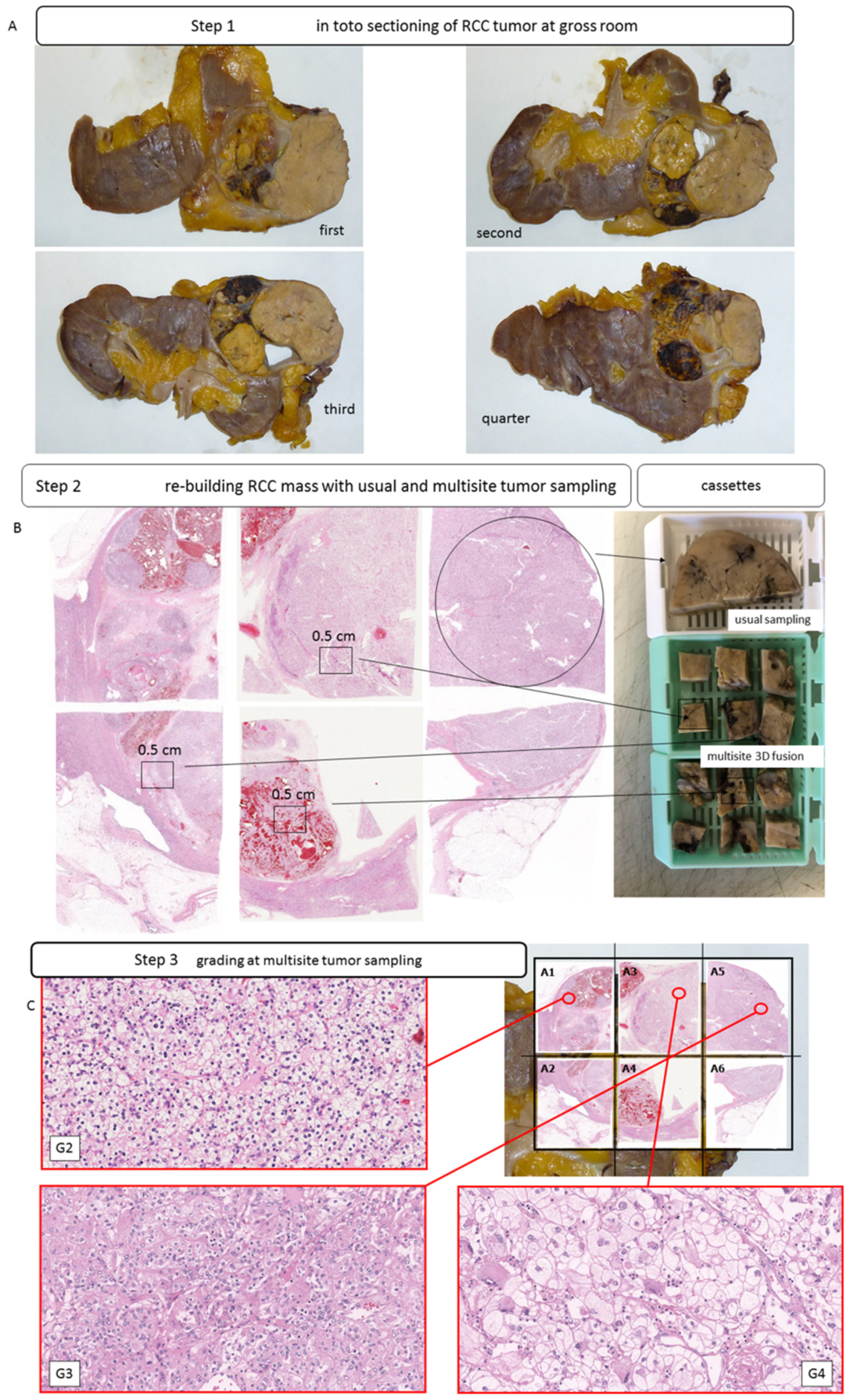 JPM | Free Full-Text | Validation of a Novel Three-Dimensional (3D Fusion)  Gross Sampling Protocol for Clear Cell Renal Cell Carcinoma to Overcome  Intratumoral Heterogeneity: The Meet-Uro 18 Study | HTML