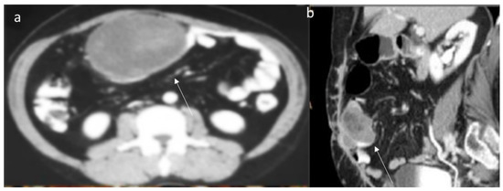 JPM | Free Full-Text | Multimodality Imaging Assessment of Desmoid Tumors:  The Great Mime in the Era of Multidisciplinary Teams