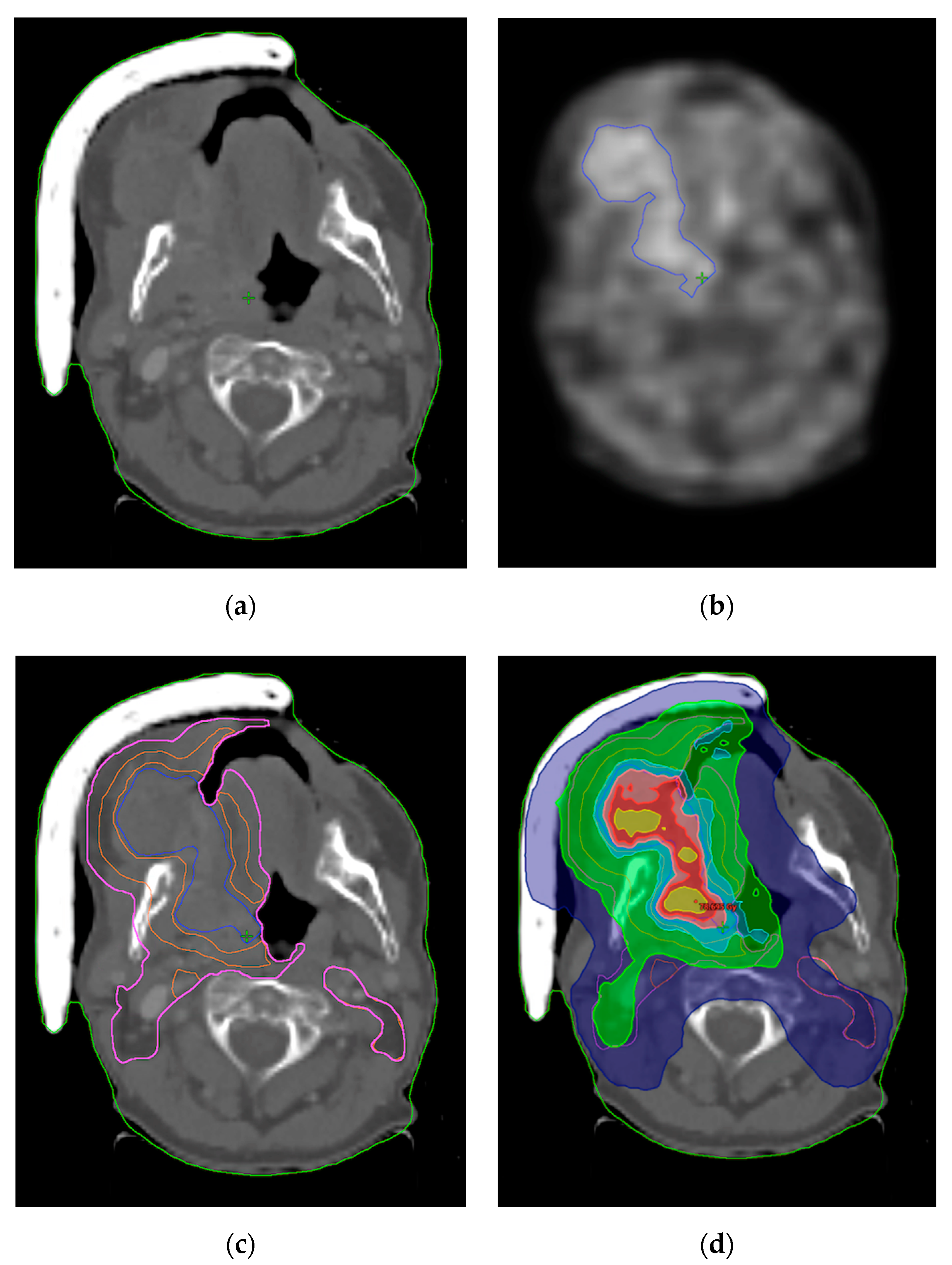JPM | Free Full-Text | FMISO-Based Adaptive Radiotherapy in Head and Neck  Cancer | HTML