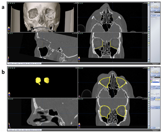 JPM | Free Full-Text | Prospective Evaluation of Two Wall Orbital ...