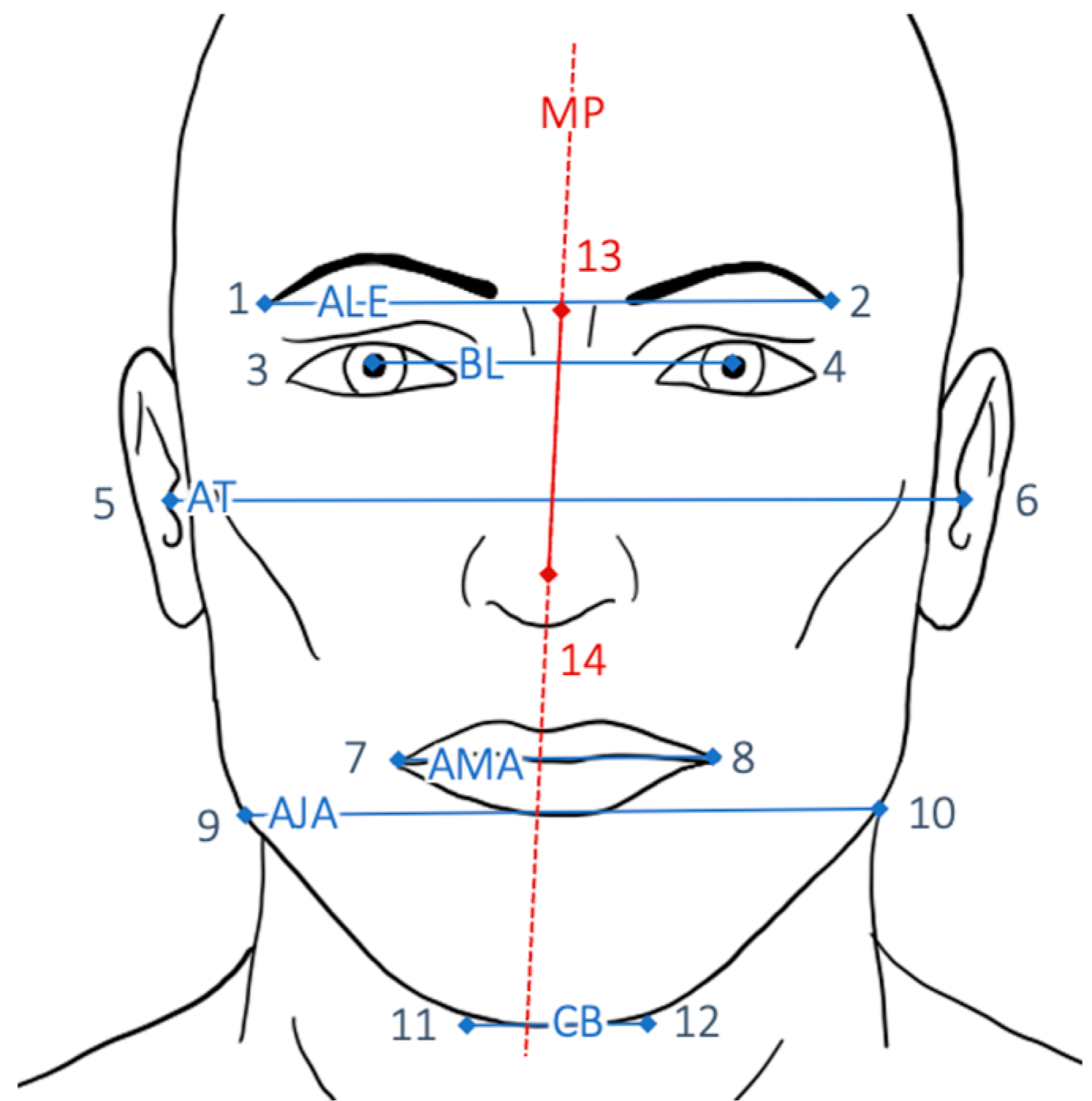 JPM | Free Full-Text | Simultaneous PSI-Based Orthognathic and PEEK ...