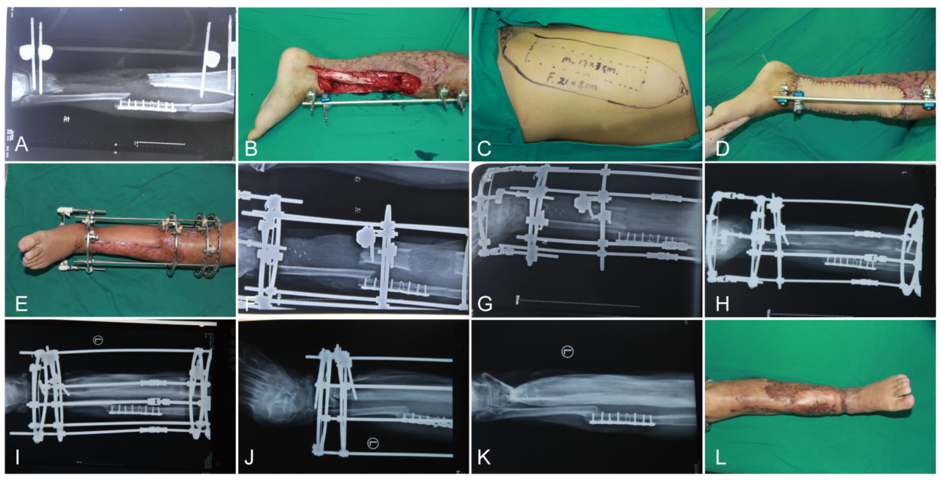 Management of post-traumatic bone defects of the tibia using vascularised  fibular graft combined with Ilizarov external fixator - ScienceDirect