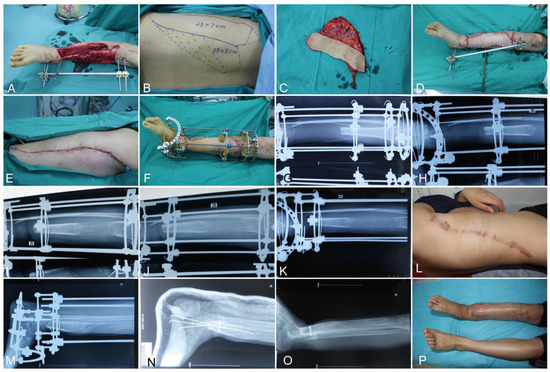 Management of post-traumatic bone defects of the tibia using vascularised  fibular graft combined with Ilizarov external fixator - ScienceDirect