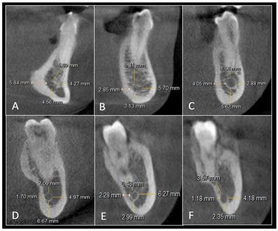 File:Mandibular Nerve.jpg - Wikimedia Commons