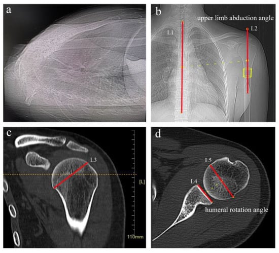 Typical magnetic resonance imaging scan showing the coracohumeral